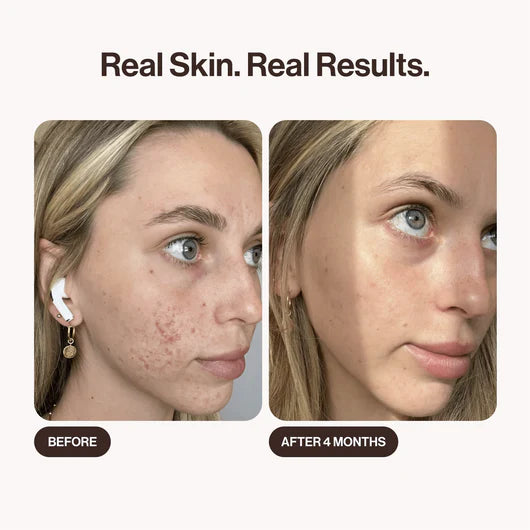 Fade Acne Scars & Restore Confidence With The Micro-Infusion Kit™